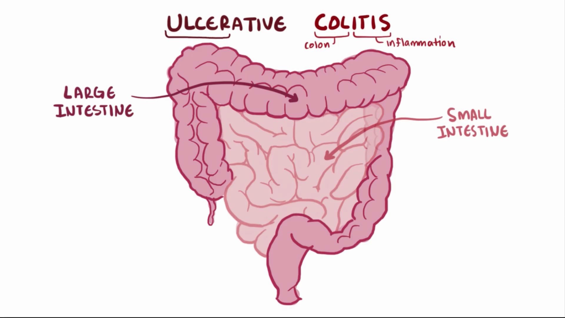 Ulcerative Colitis - Colon Liver Gastro Consultants